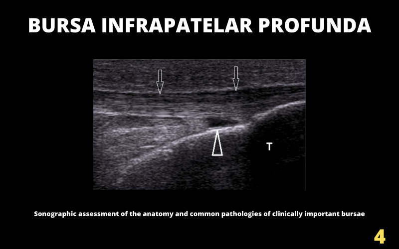 Bursas Y Ecograf A Parte Rodilla Tempo Formaci N